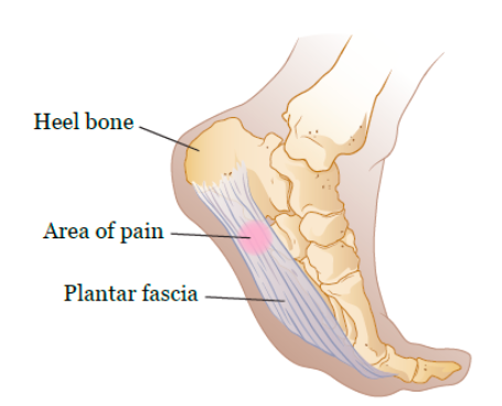 where is plantar fasciitis pain